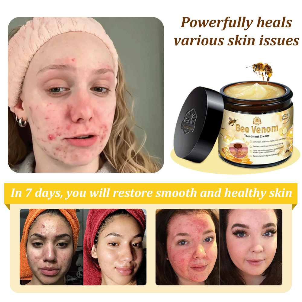 Turonu™ Bee Venom Skin Treatment Cream British Association of Dermatologists (BAD) Approved(Helping with acne, wart, rosacea, psoriasis, age spots, eczema, and reducing the appearance of stretch marks)🏵️