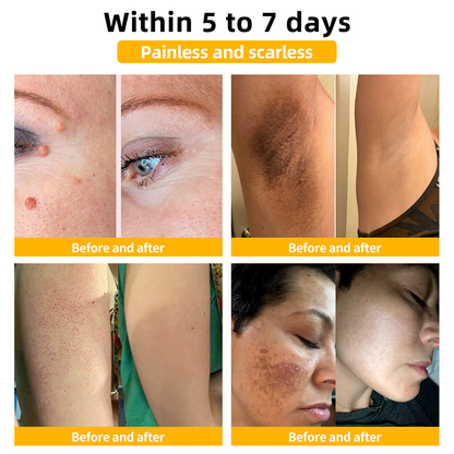Turonu™ Bee Venom Skin Treatment Cream British Association of Dermatologists (BAD) Approved(Helping with acne, wart, rosacea, psoriasis, age spots, eczema, and reducing the appearance of stretch marks)🏵️
