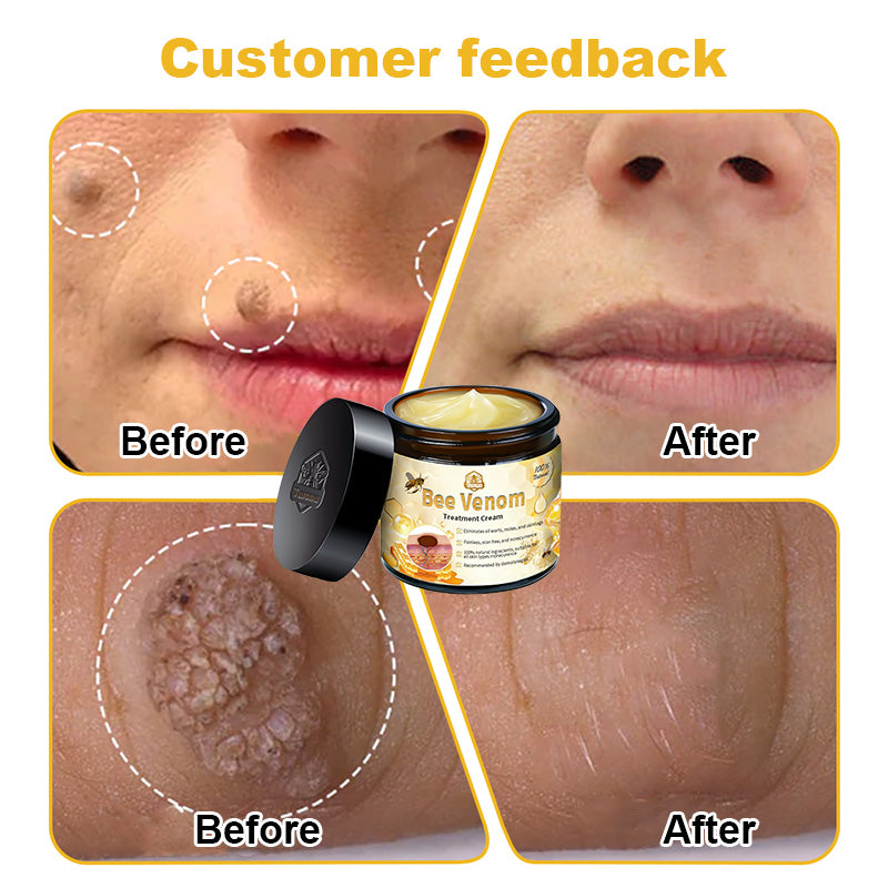 Turonu™ Bee Venom Skin Treatment Cream British Association of Dermatologists (BAD) Approved(Helping with acne, wart, rosacea, psoriasis, age spots, eczema, and reducing the appearance of stretch marks)🏵️