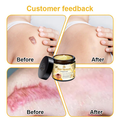 Turonu™ Bee Venom Skin Treatment Cream British Association of Dermatologists (BAD) Approved(Helping with acne, wart, rosacea, psoriasis, age spots, eczema, and reducing the appearance of stretch marks)🏵️